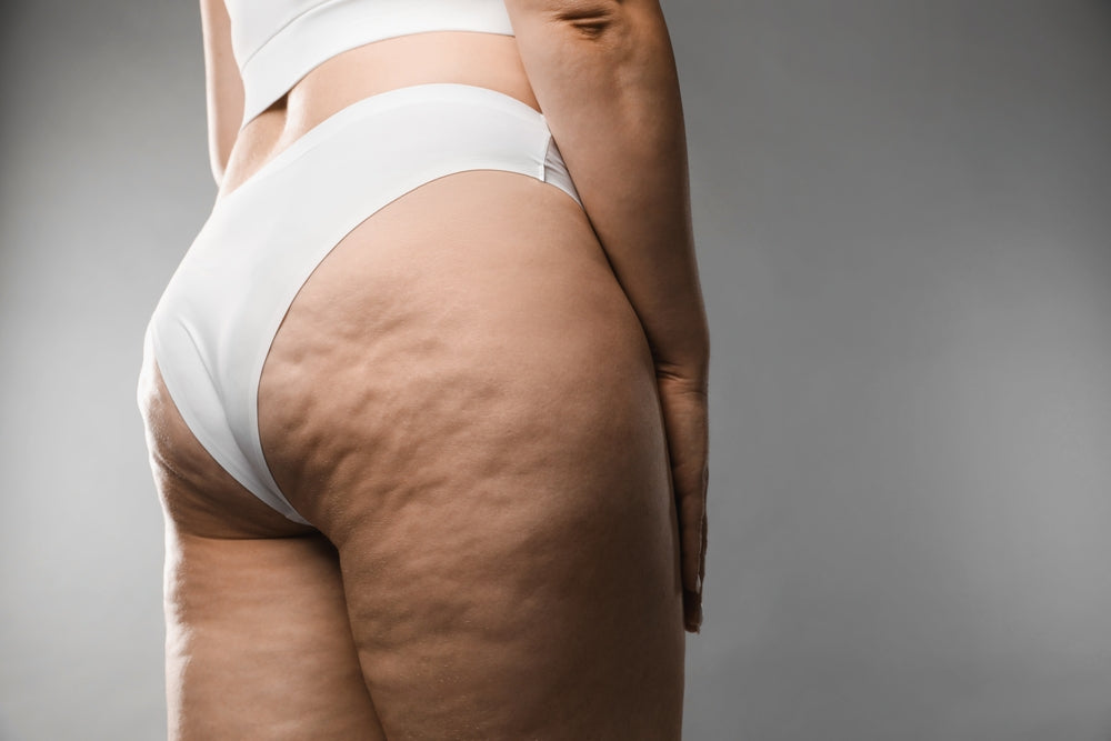Suplementos para combater a celulite