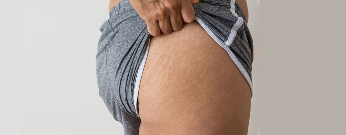 6 dicas de como acabar com as estrias